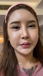 ​网红桃花宝宝近况，额头大坑刚恢复，又曝整容后遗症脸部经常抽搐